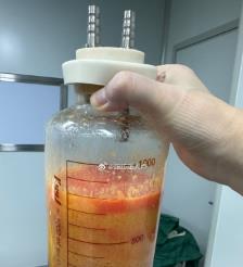 马鞍山水动力吸脂手术要做多久？